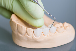 Ceramic model of dental bridge