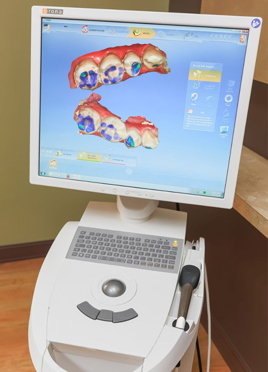 Digital rendering of teeth by Cerec software
