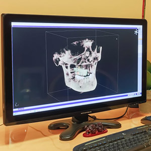 3D x-ray of jaw on chairside monitor