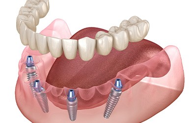A CGI image of All-on-4 dentures