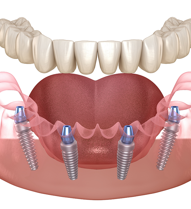 Illustration of an All-on-4 implant denture being placed