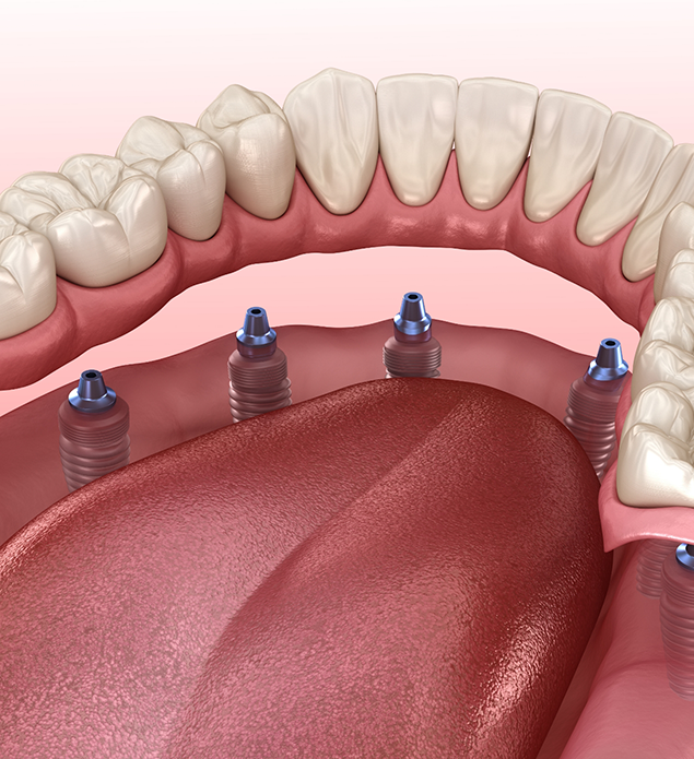 Illustration of a full denture being secured onto six dental implants throughout the lower jaw