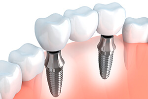Animation of dental implant supported bridge