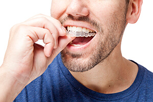 Man placing Invisalign alignment tray