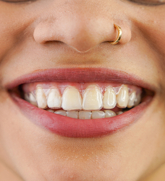 Close up of a person smiling with a clear aligner over their teeth