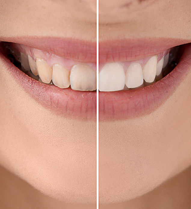 Close up of a smile before and after cosmetic dentistry