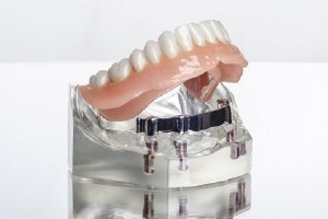 Implant retained denture