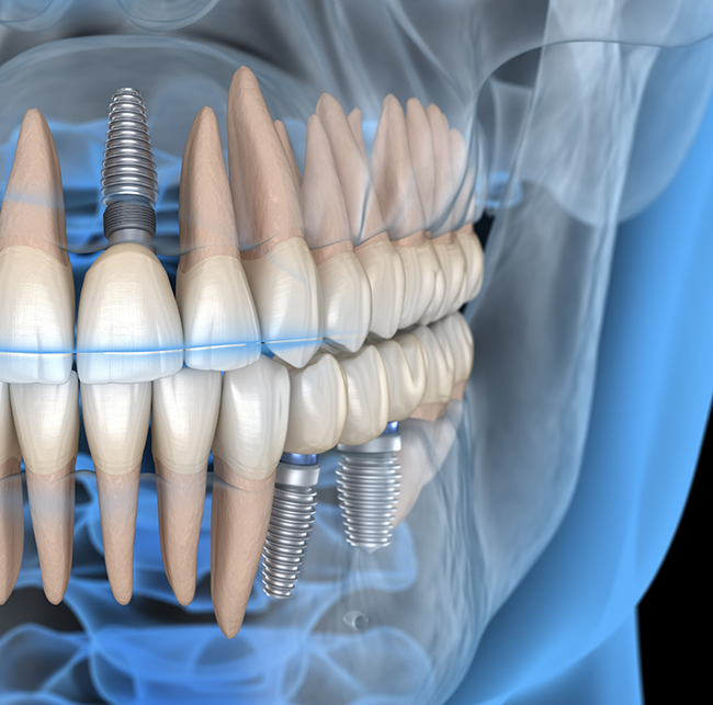 Illustrated x-ray of a person's mouth with two dental implants in Sparks