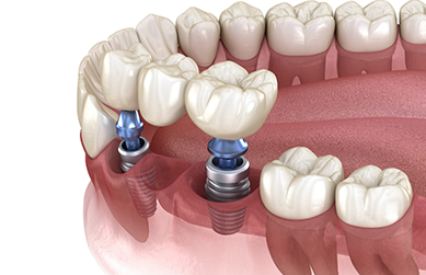 Two illustrated dental implants with a dental bridge