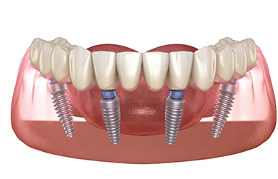 Four illustrated dental implants supporting a full denture