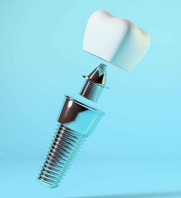 Illustration of a dental implant with a crown and an abutment