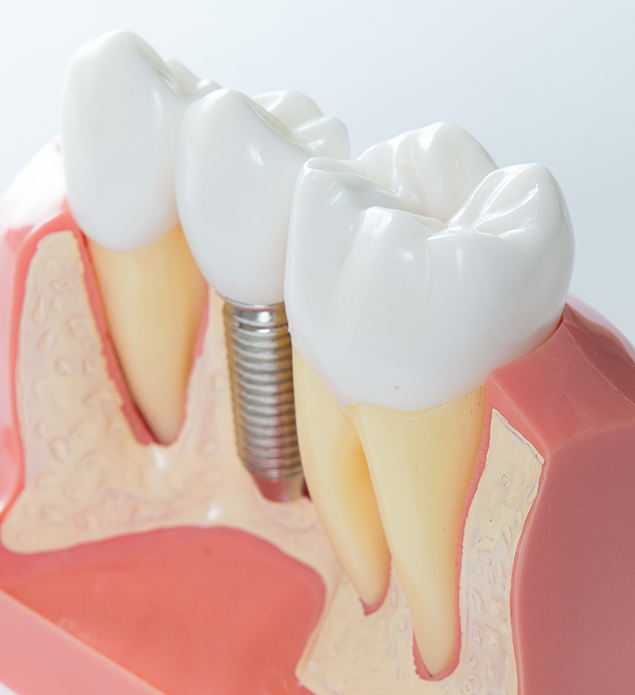 Model of a dental implant between two natural teeth