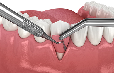 Illustration of soft tissue being grafted over receding gum tissue