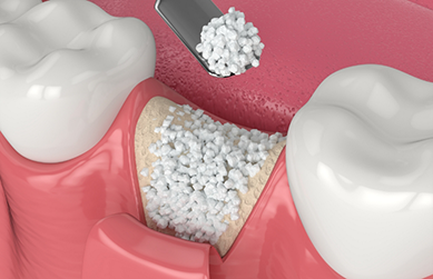 Illustration of bone grafting material being placed in the jawbone where a tooth is missing