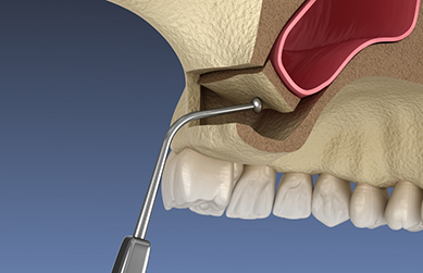 Illustration of a thin instrument gently lifting the upper sinus membrane