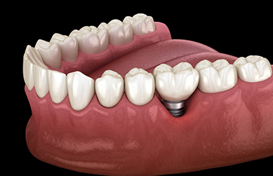Illustrated dental implant with a crown
