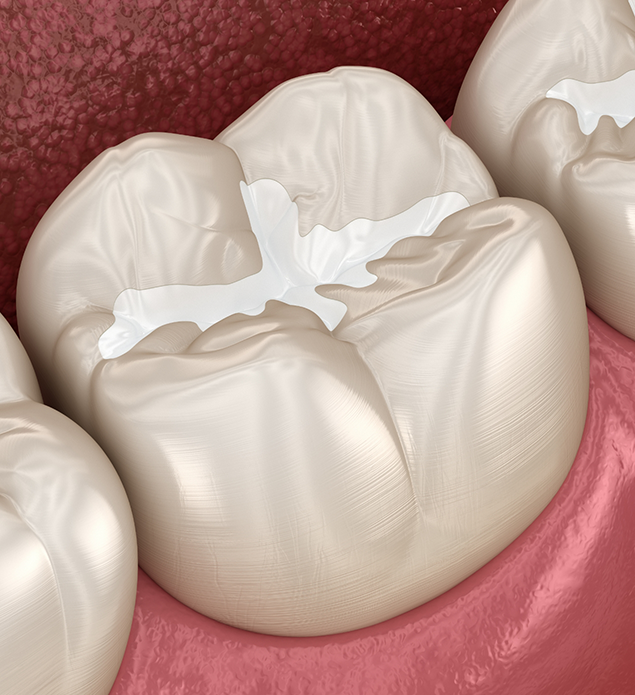 Illustration of a tooth with a sealant