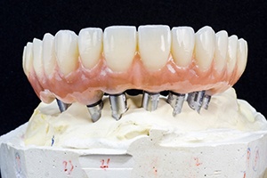  Example of implant dentures in Sparks 