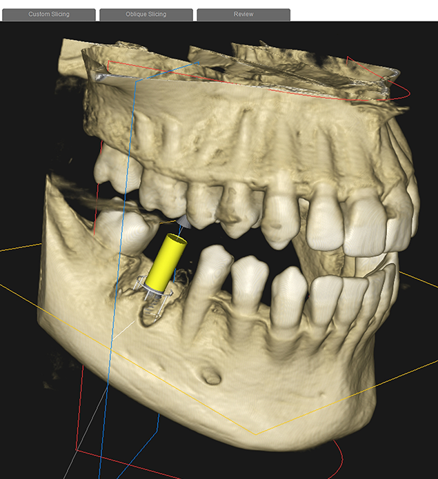 Digital model of a person's teeth and jaws