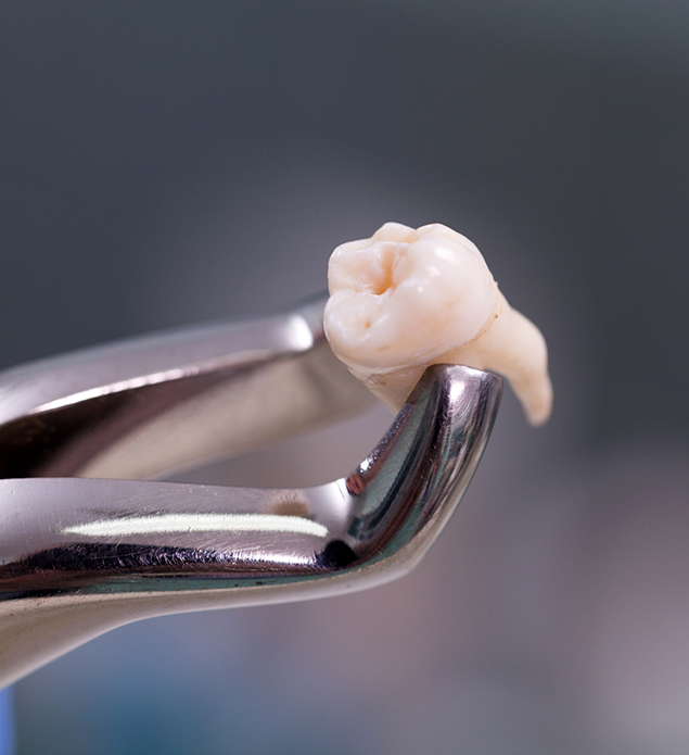 Dental forceps holding an extracted tooth