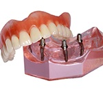 Model of implant supported denture