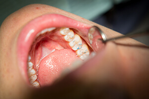 dentist examining patient's mouth after filling placement