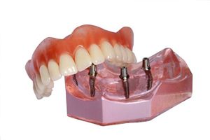 Model implant denture