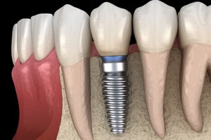 Illustration of dental implant in Sparks, NV in jawbone