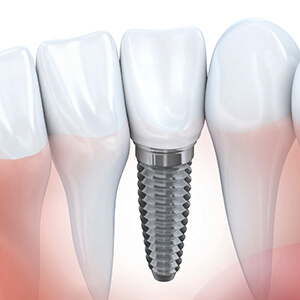 Sparks Dental Implant Animation