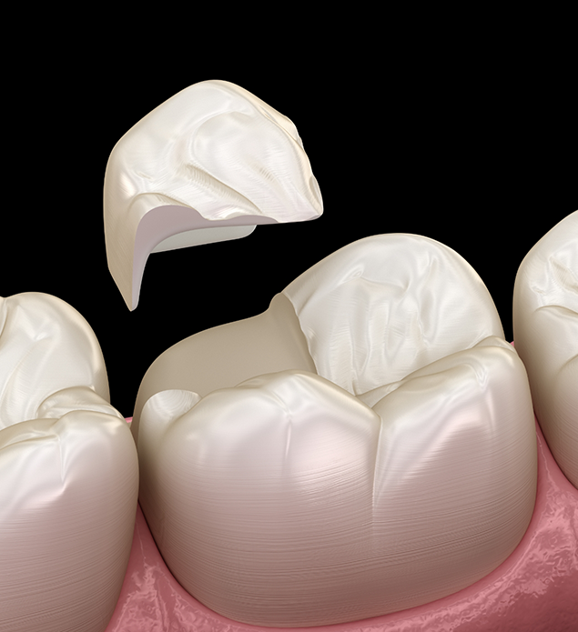 Illustrated dental inlay being placed on a broken tooth
