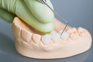 Ceramic model of dental bridge