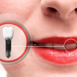 single tooth implant