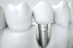 dental implant