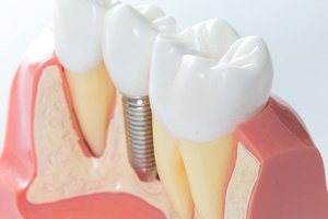 model of dental implant