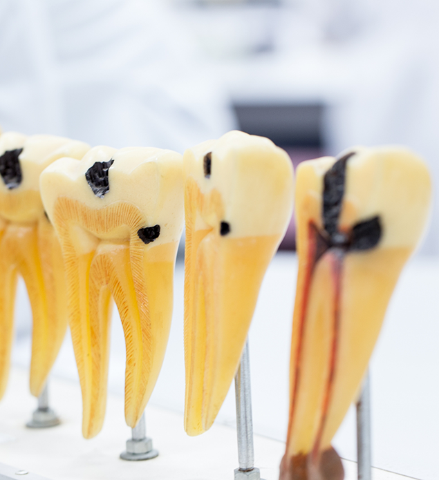 Models of decayed teeth that need root canal treatment