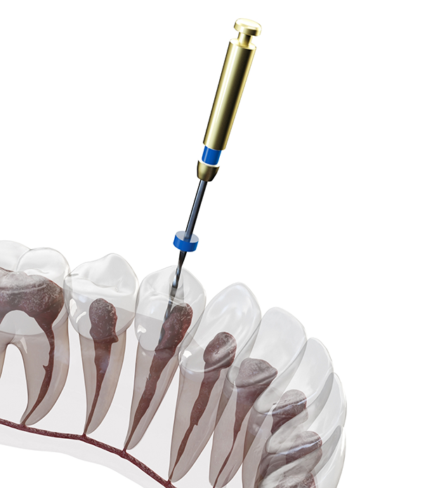 Illustrated dental instrument treating the inside of a tooth