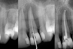 X-ray image of tooth undergoing root canal therapy