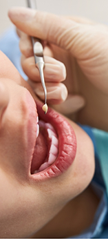 Dentist placing a filling in a tooth