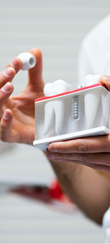 Dentist holding a model of a dental implant