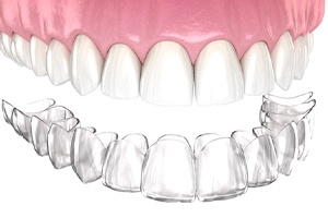 Illustration of SureSmile aligner being placed on teeth