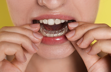 Person placing an aligner over their lower teeth