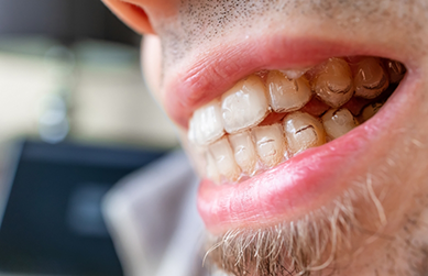 Close up of a smiling man with clear aligners over his teeth