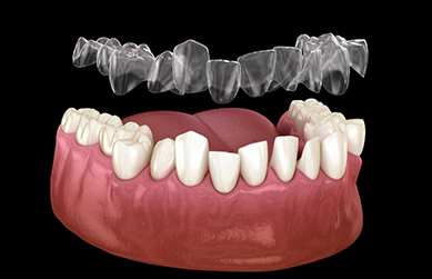 Illustration of an aligner being placed over crooked teeth