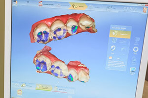 Digital smile impressions of teeth