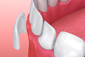 Closeup animation of porcelain veneer treatment