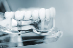 Cross-section of dental implant