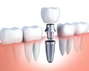 dental implant in Sparks
