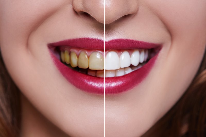 A before-and-after photo of a woman's tooth color