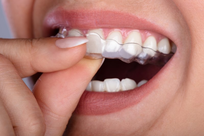 A woman removing clear aligners in Sparks