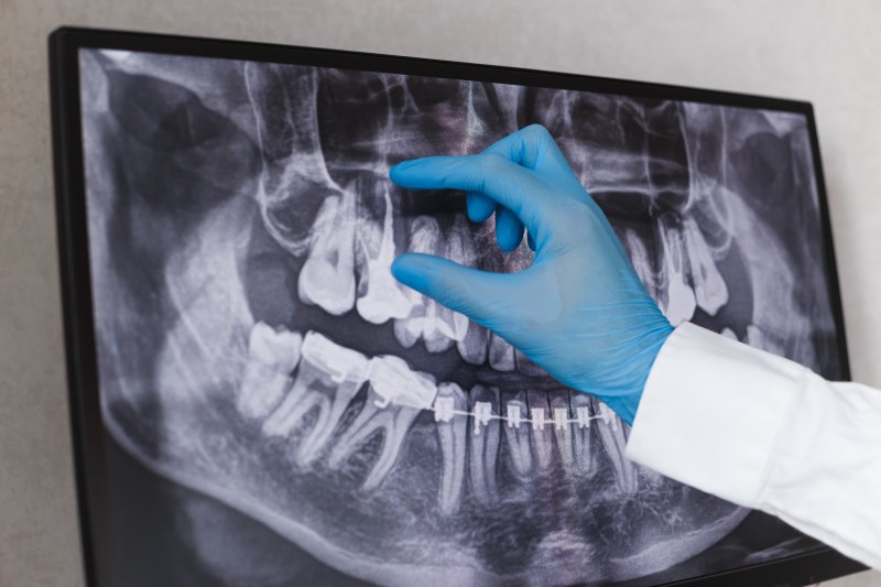 A close-up of dental x-rays